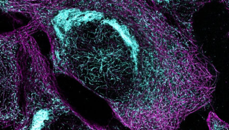 Kolay bir kan testi Alzheimer’in hangi basamakta olduğunu gösterebiliyor
