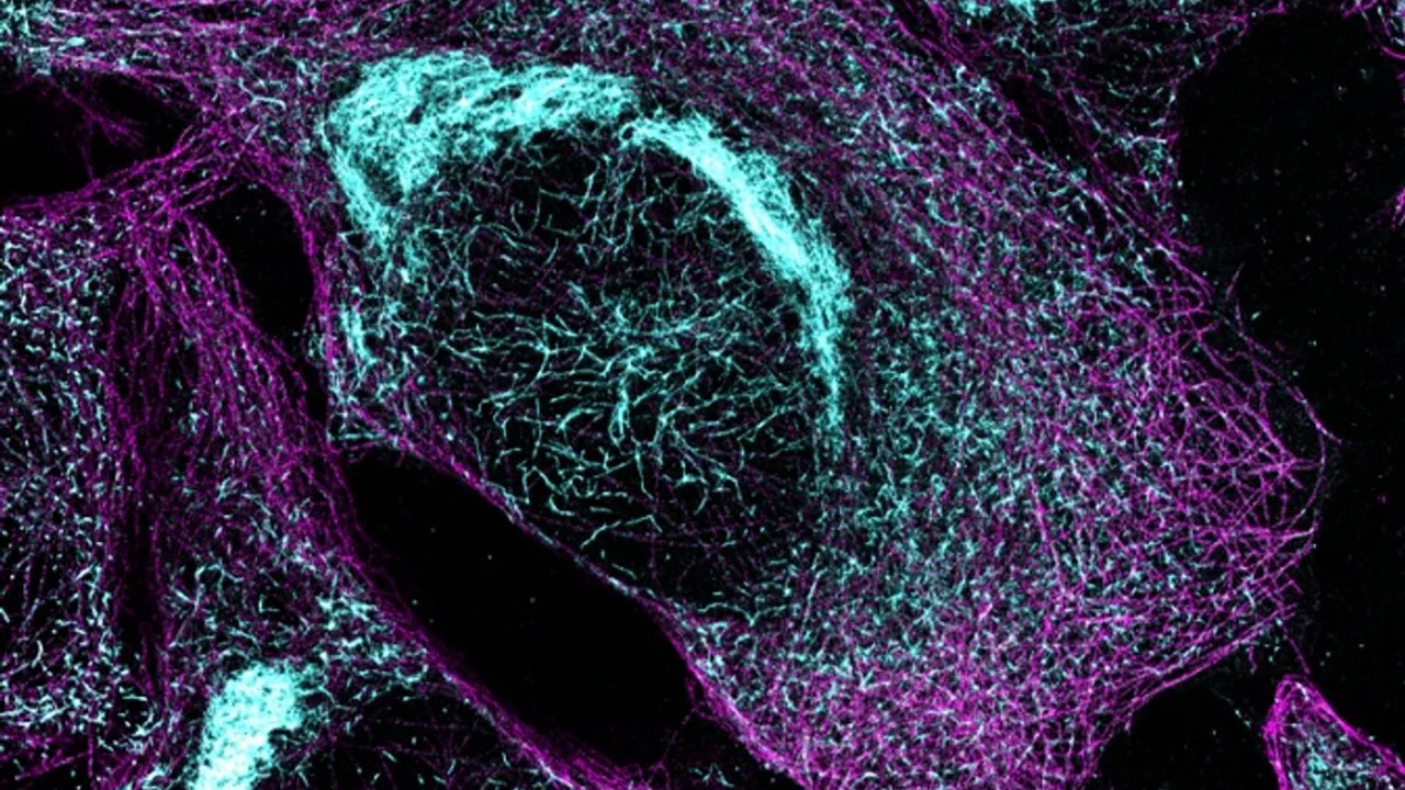 Kolay bir kan testi Alzheimer’in hangi basamakta olduğunu gösterebiliyor